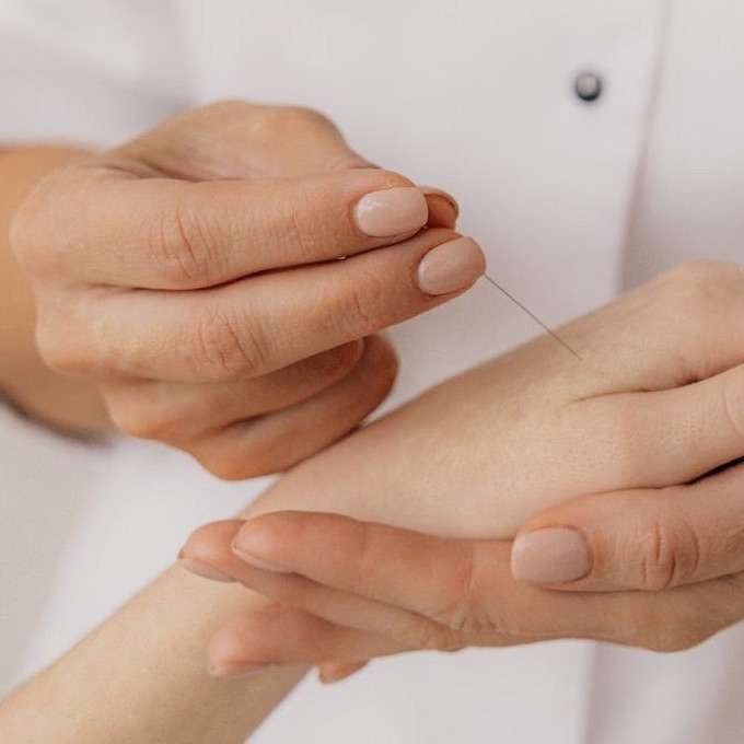 In home acupuncture for hand in Calgary.