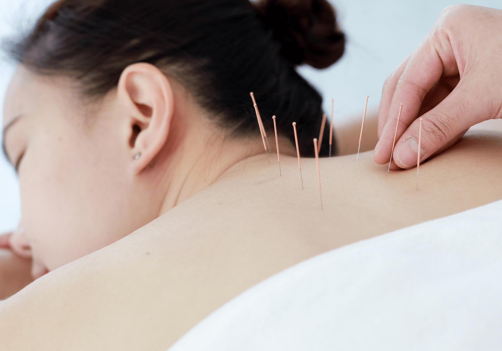woman in edmonton getting in home acupuncture in edmonton
