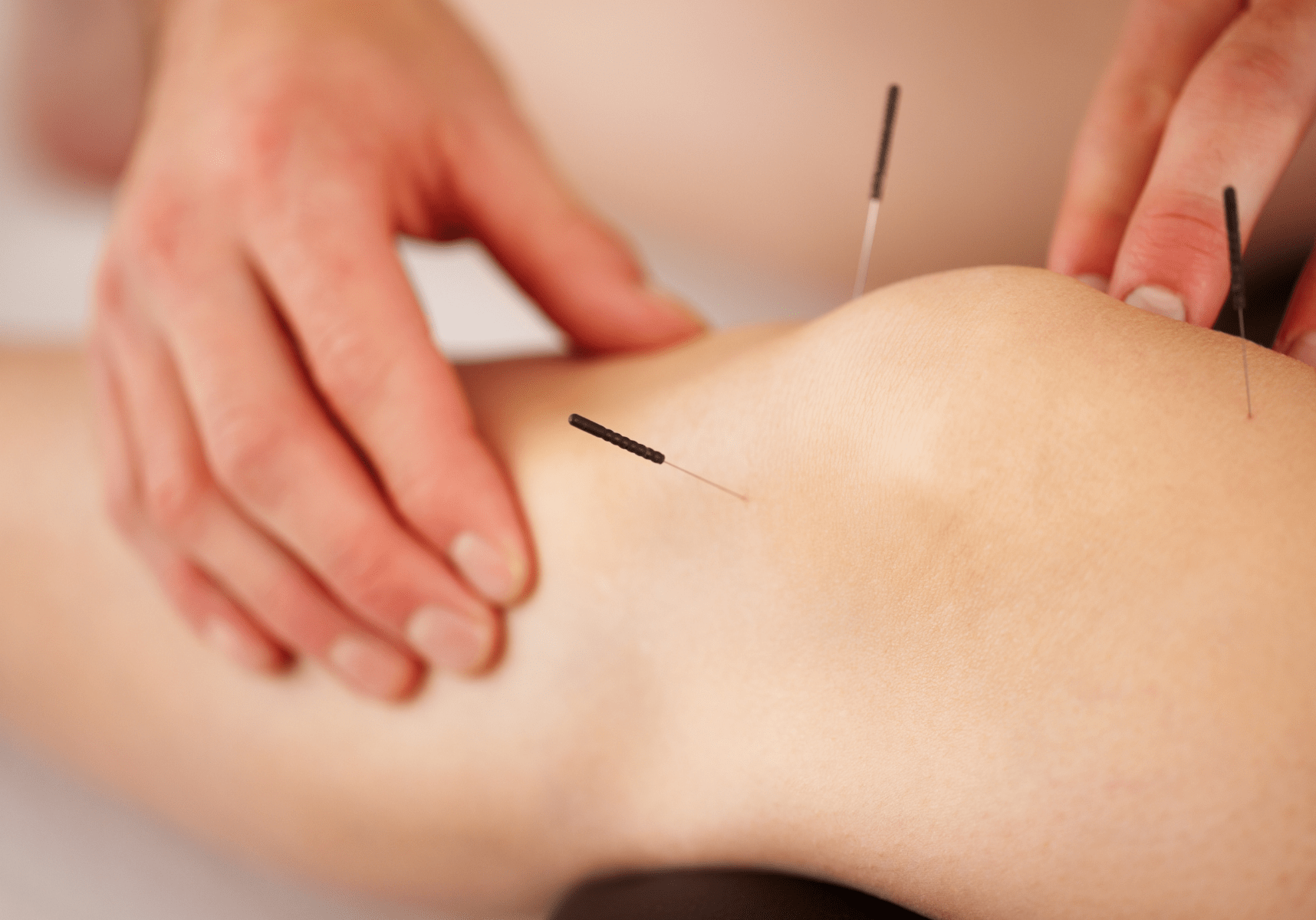 in home knee acupuncture for patient in calgary